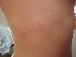 A red itchy looking sea lice rach on the torso of a swimmer.