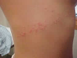 swimmers itch rash pictures