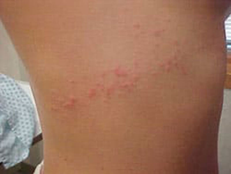 Sea Lice: That Nasty Rash You Get After Swimming In The Ocean